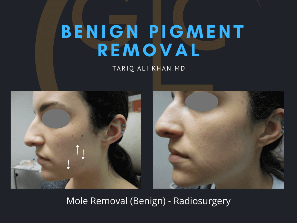 Gentle Care Laser Tustin & Long Beach Before and After picture - Mole Removal